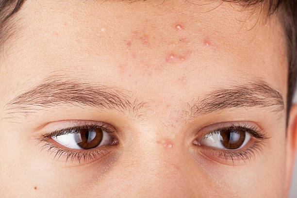 A Close Up Of A Boy 's Face — Pittsburgh, PA — South Hills Dermatology, PC