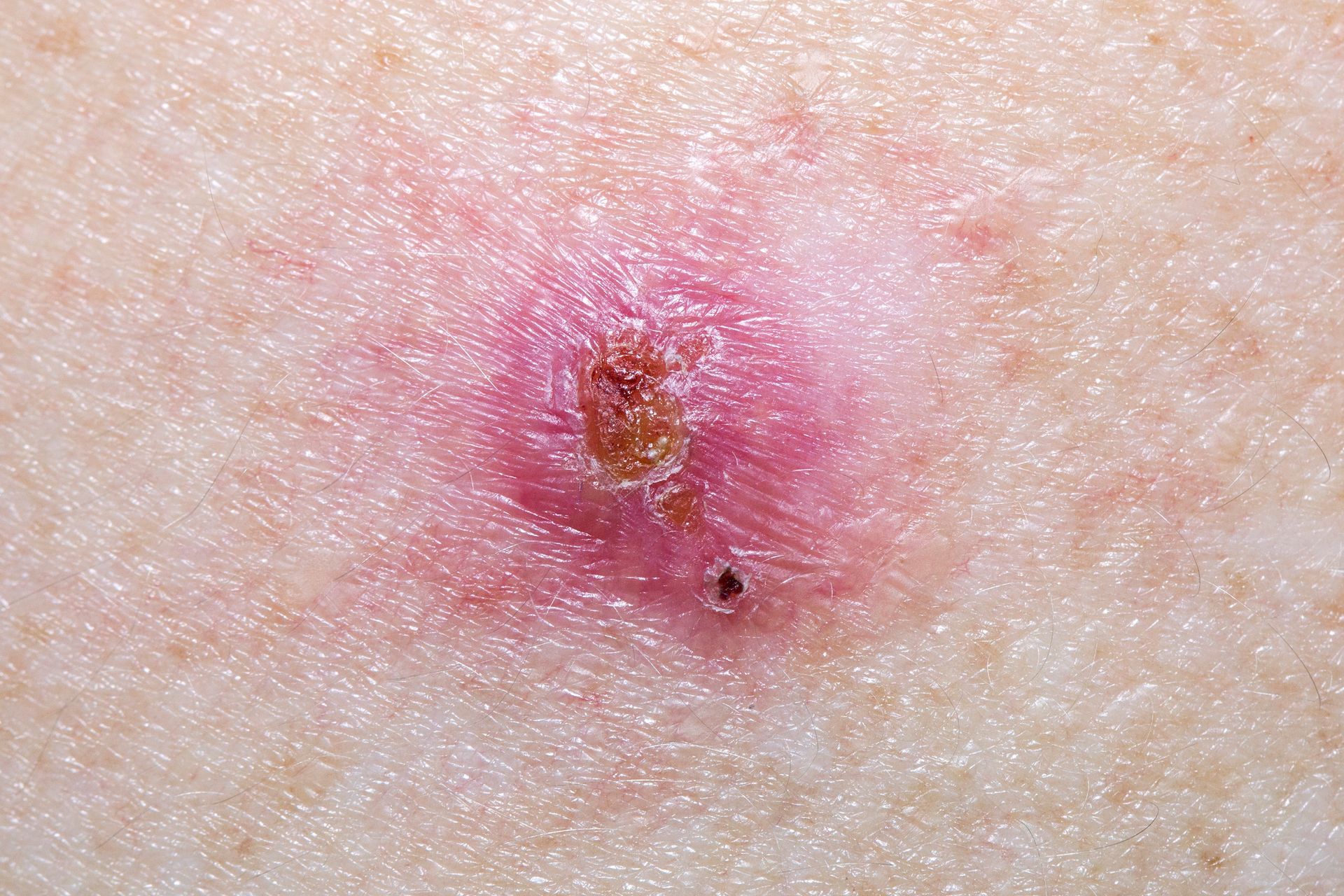 A close up of a red spot on a person 's skin. — Pittsburgh, PA — South Hills Dermatology, PC