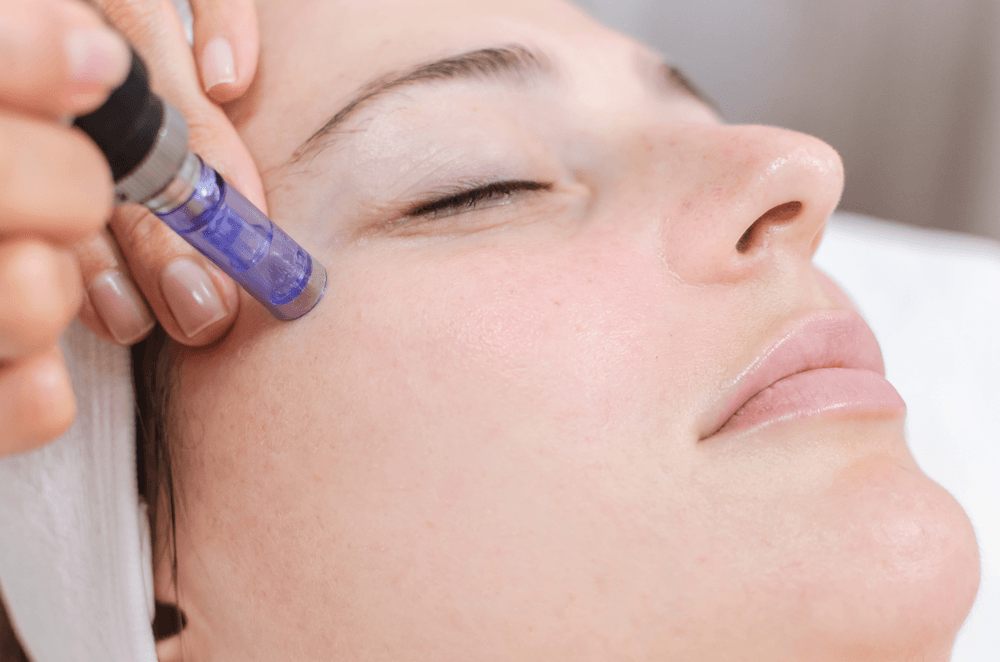Woman receiving microneedling treatment on her face. A device is held to her cheek.