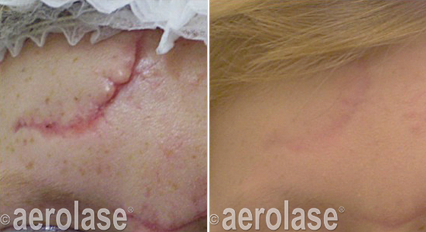 Laser Scar Removal Mississauga | Aerolase Scar Treatment