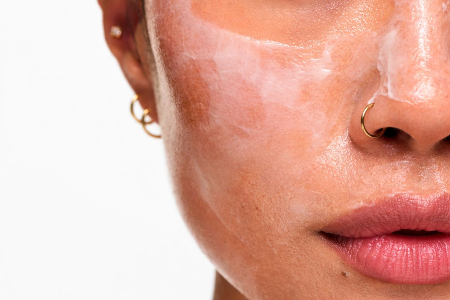 Hyperpigmentation treatment for dark spots and uneven skin tone at Luxe Beauty Mississauga