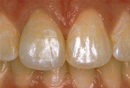 porcelain crowns  after