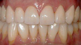 porcelain crowns  after