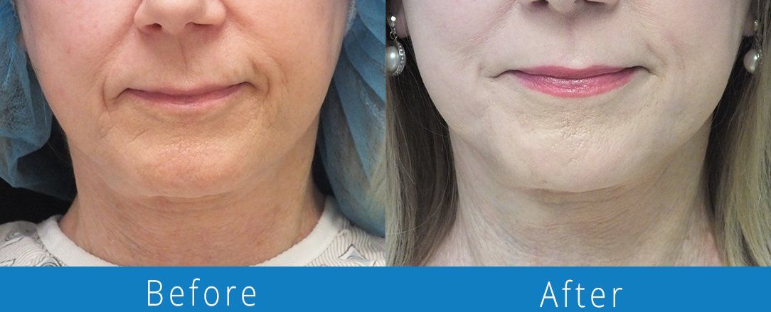 CO2 laser before & after from Beaches Facial Plastic & Nasal Surgery Center - the top place for CO2 laser treatment in Jacksonville or Northeast Florida. 