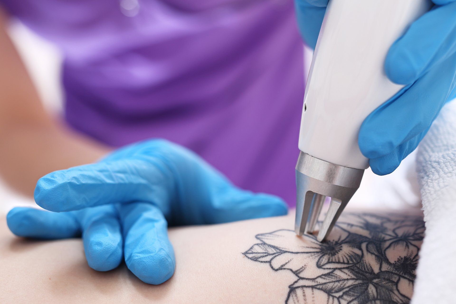 Tattoo removal from Faces Only - the top place for tattoo removal treatment in Jacksonville or Northeast Florida. 