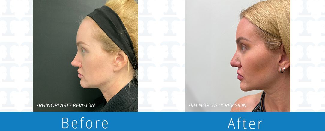 Rhinoplasty before & after from Beaches Facial Plastic & Nasal Surgery Center - the top surgeon for a rhinoplasty or nose job surgery in Jacksonville or Northeast Florida. 