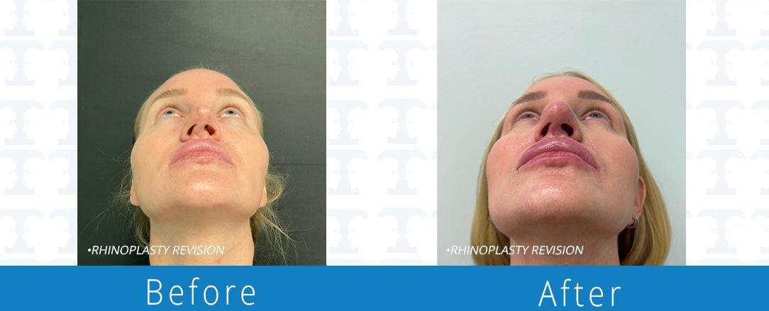 Rhinoplasty before & after from Beaches Facial Plastic & Nasal Surgery Center - the top surgeon for a rhinoplasty or nose job surgery in Jacksonville or Northeast Florida. 