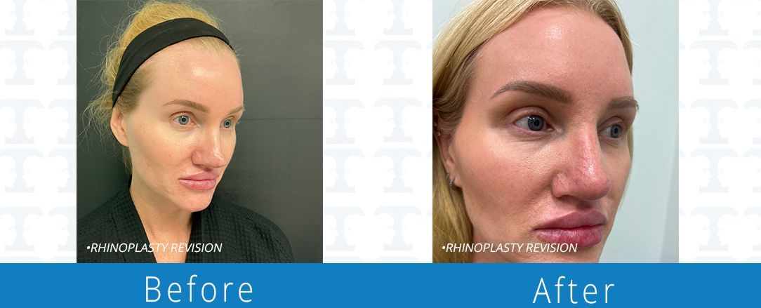 Rhinoplasty before & after from Beaches Facial Plastic & Nasal Surgery Center - the top surgeon for a rhinoplasty or nose job surgery in Jacksonville or Northeast Florida. 