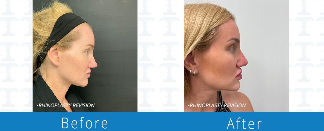 Rhinoplasty before & after from Beaches Facial Plastic & Nasal Surgery Center - the top surgeon for a rhinoplasty or nose job surgery in Jacksonville or Northeast Florida. 