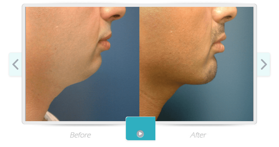 Mentoplasty/Genioplasty or surgery of the chin before & after from Beaches Facial Plastic & Nasal Surgery Center - the top surgeon for a mentoplasty, chin surgery, or chin fat removal in Jacksonville or Northeast Florida. 