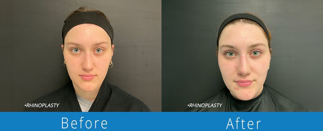 Rhinoplasty before & after from Beaches Facial Plastic & Nasal Surgery Center - the top surgeon for a rhinoplasty or nose job surgery in Jacksonville or Northeast Florida. 