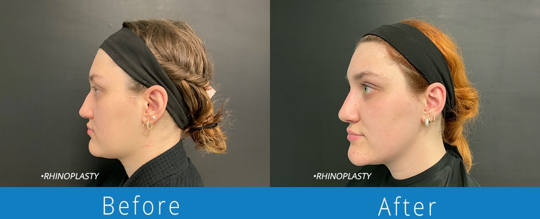 Rhinoplasty before & after from Beaches Facial Plastic & Nasal Surgery Center - the top surgeon for a rhinoplasty or nose job surgery in Jacksonville or Northeast Florida. 