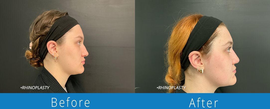 Rhinoplasty before & after from Beaches Facial Plastic & Nasal Surgery Center - the top surgeon for a rhinoplasty or nose job surgery in Jacksonville or Northeast Florida. 