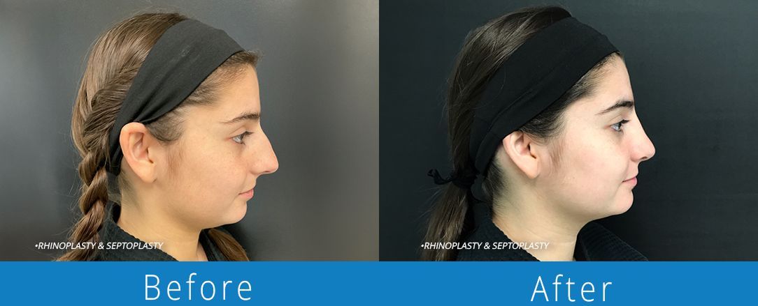 Rhinoplasty before & after from Beaches Facial Plastic & Nasal Surgery Center - the top surgeon for a rhinoplasty or nose job surgery in Jacksonville or Northeast Florida. 