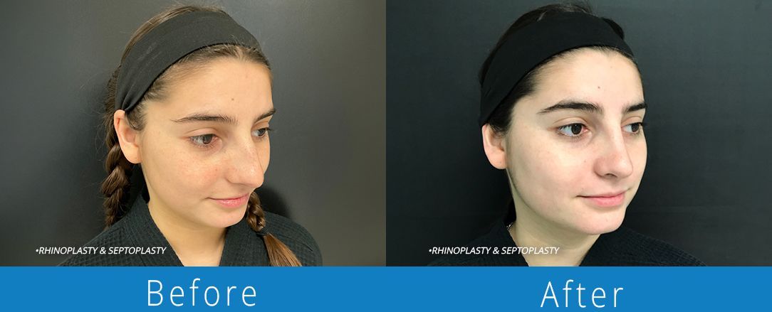 Rhinoplasty before & after from Beaches Facial Plastic & Nasal Surgery Center - the top surgeon for a rhinoplasty or nose job surgery in Jacksonville or Northeast Florida. 
