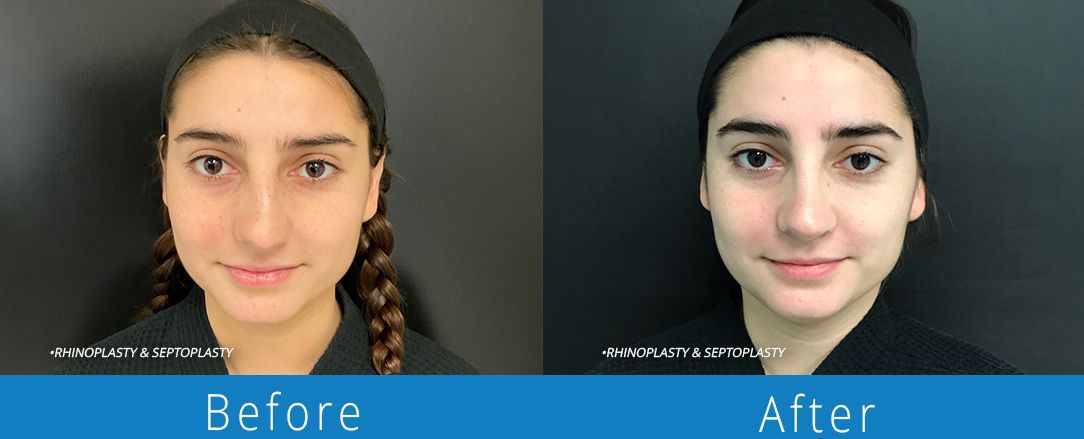 Rhinoplasty before & after from Beaches Facial Plastic & Nasal Surgery Center - the top surgeon for a rhinoplasty or nose job surgery in Jacksonville or Northeast Florida. 