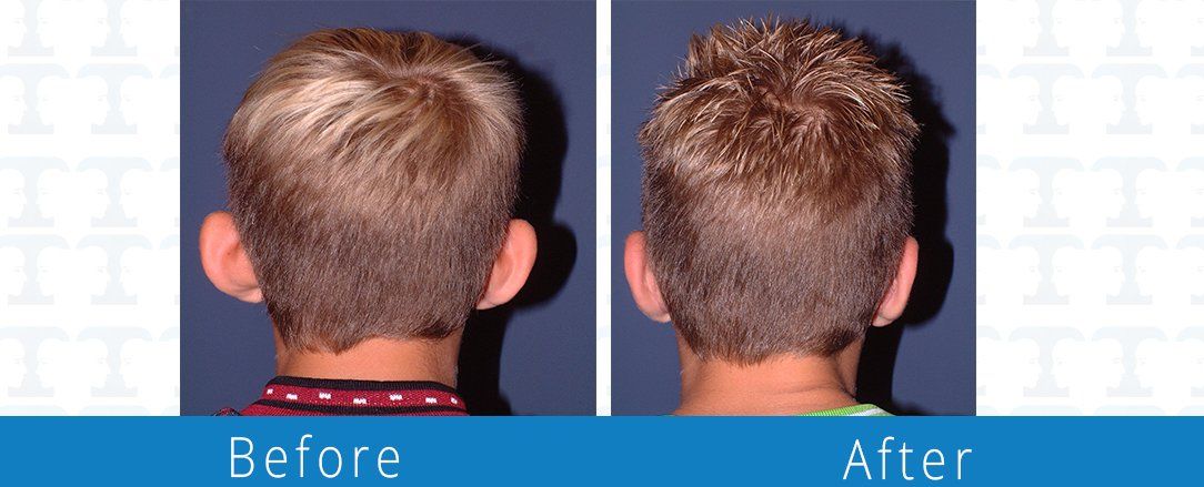 Otoplasty or earlobe surgery before & after from Beaches Facial Plastic & Nasal Surgery Center and the premiere spot for an otoplasty or earlobe surgery in Northeast Florida.