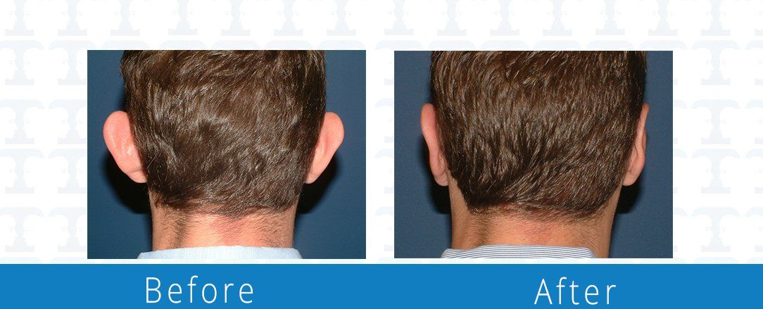 Otoplasty or earlobe surgery before & after from Beaches Facial Plastic & Nasal Surgery Center and the premiere spot for an otoplasty or earlobe surgery in Northeast Florida.