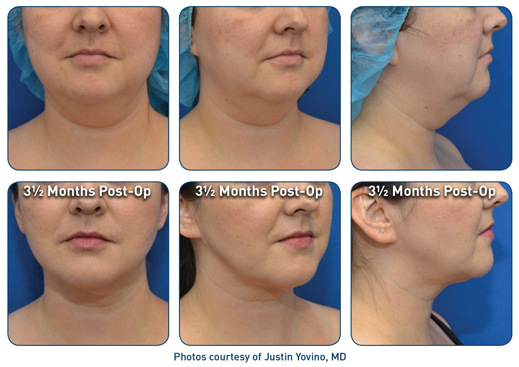 Renuvion laser before & after from Beaches Facial Plastic & Nasal Surgery Center - the top place for Renuvion laser treatment in Jacksonville or Northeast Florida.