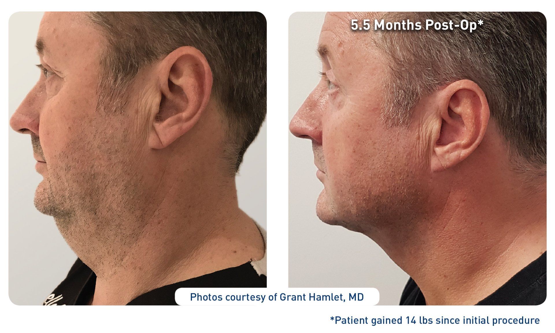 Renuvion laser before & after from Beaches Facial Plastic & Nasal Surgery Center - the top place for Renuvion laser treatment in Jacksonville or Northeast Florida.