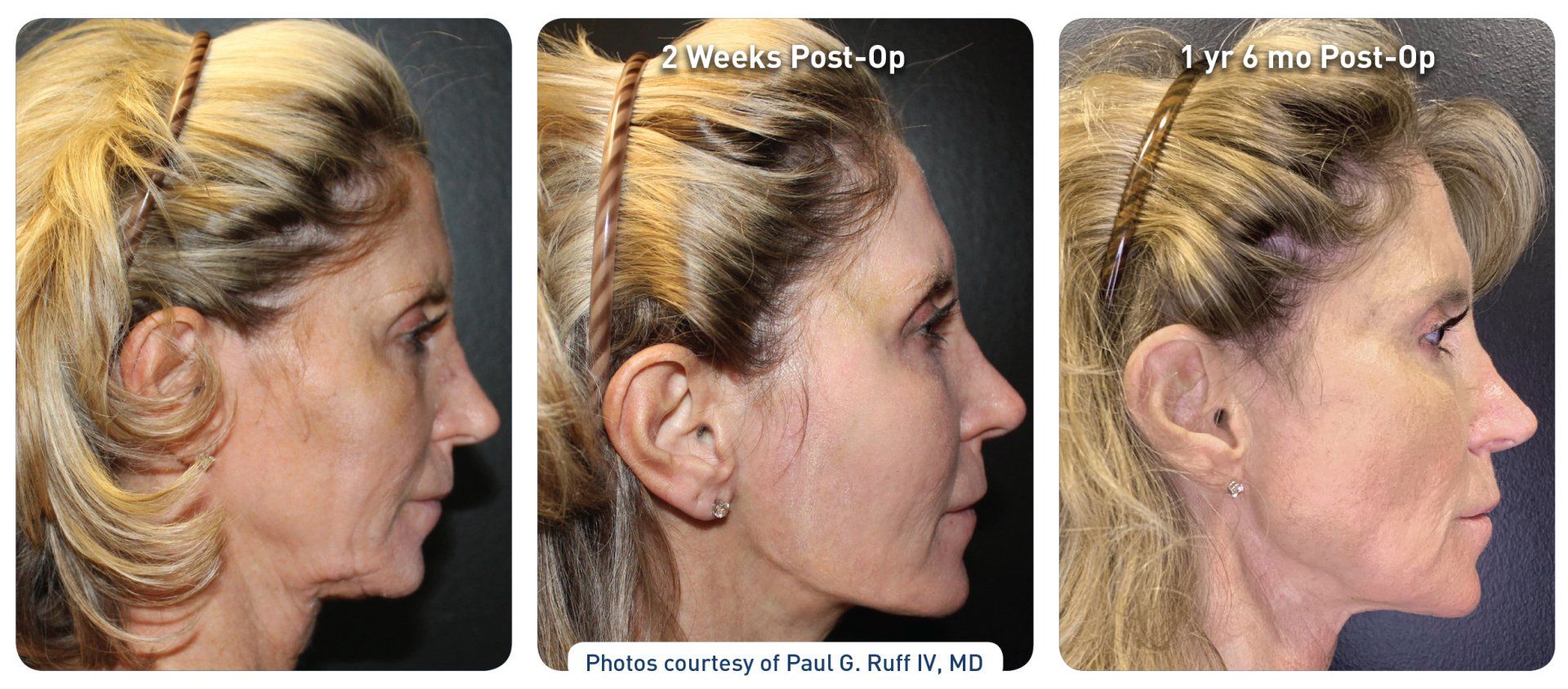 Renuvion laser before & after from Beaches Facial Plastic & Nasal Surgery Center - the top place for Renuvion laser treatment in Jacksonville or Northeast Florida.