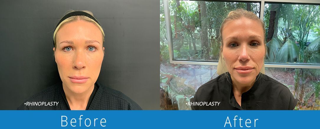 Rhinoplasty before & after from Beaches Facial Plastic & Nasal Surgery Center - the top surgeon for a rhinoplasty or nose job surgery in Jacksonville or Northeast Florida. 