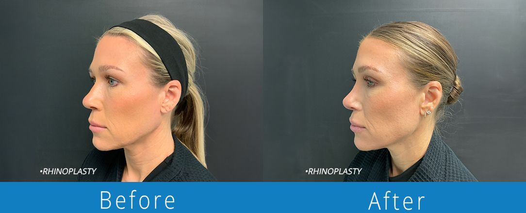 Rhinoplasty before & after from Beaches Facial Plastic & Nasal Surgery Center - the top surgeon for a rhinoplasty or nose job surgery in Jacksonville or Northeast Florida. 