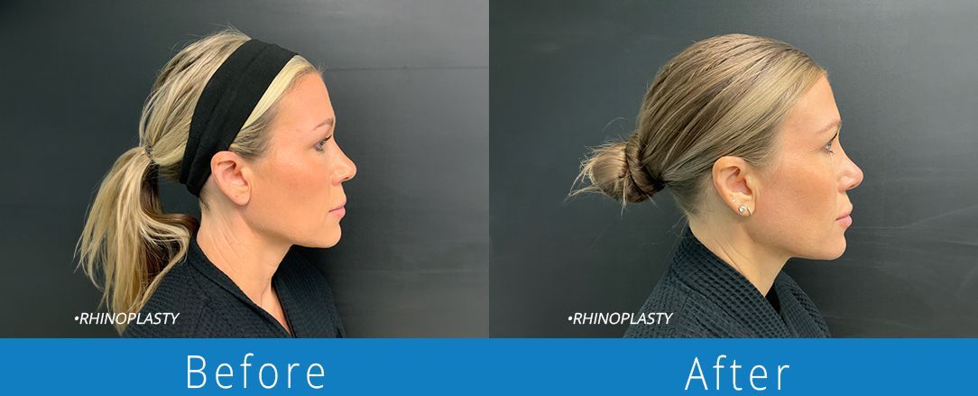 Rhinoplasty before & after from Beaches Facial Plastic & Nasal Surgery Center - the top surgeon for a rhinoplasty or nose job surgery in Jacksonville or Northeast Florida. 