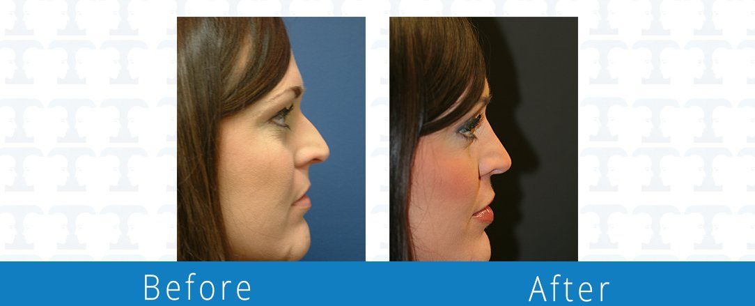 Rhinoplasty before & after from Beaches Facial Plastic & Nasal Surgery Center - the top surgeon for a rhinoplasty or nose job surgery in Jacksonville or Northeast Florida. 