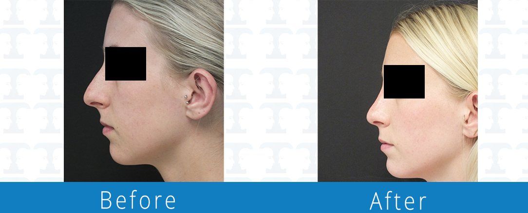 Rhinoplasty before & after from Beaches Facial Plastic & Nasal Surgery Center - the top surgeon for a rhinoplasty or nose job surgery in Jacksonville or Northeast Florida. 