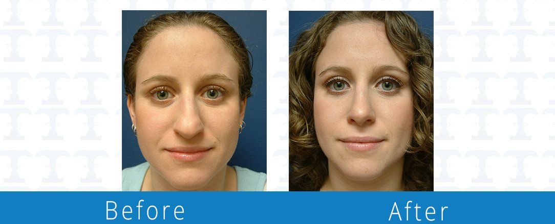 Rhinoplasty before & after from Beaches Facial Plastic & Nasal Surgery Center - the top surgeon for a rhinoplasty or nose job surgery in Jacksonville or Northeast Florida. 