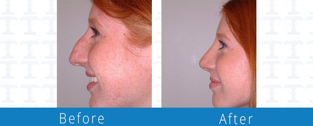 Rhinoplasty before & after from Beaches Facial Plastic & Nasal Surgery Center - the top surgeon for a rhinoplasty or nose job surgery in Jacksonville or Northeast Florida. 