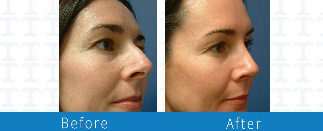 Rhinoplasty before & after from Beaches Facial Plastic & Nasal Surgery Center - the top surgeon for a rhinoplasty or nose job surgery in Jacksonville or Northeast Florida. 