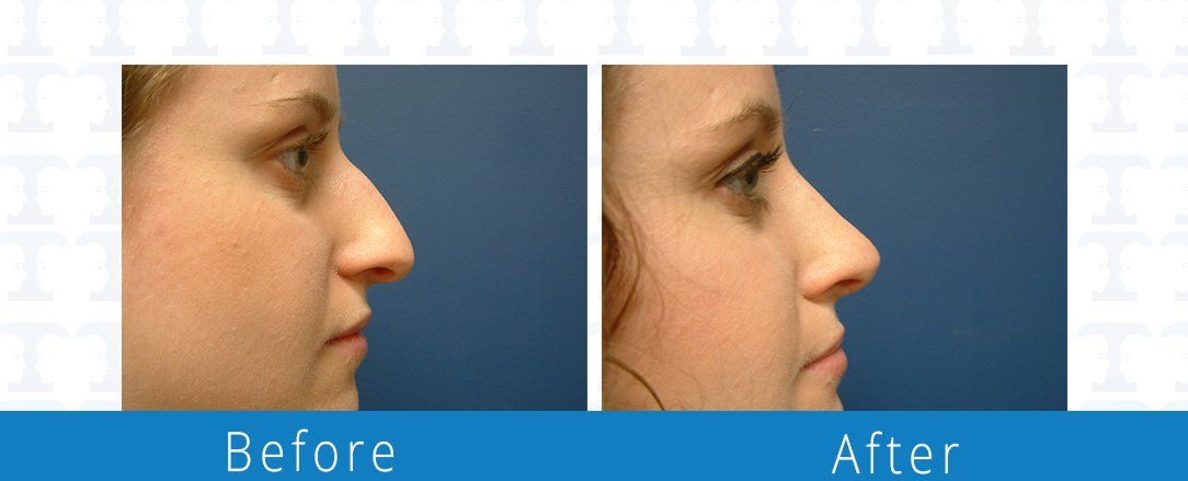 Rhinoplasty before & after from Beaches Facial Plastic & Nasal Surgery Center - the top surgeon for a rhinoplasty or nose job surgery in Jacksonville or Northeast Florida. 