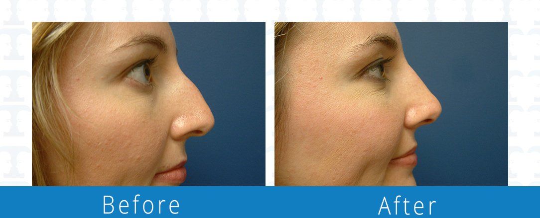 Rhinoplasty before & after from Beaches Facial Plastic & Nasal Surgery Center - the top surgeon for a rhinoplasty or nose job surgery in Jacksonville or Northeast Florida. 