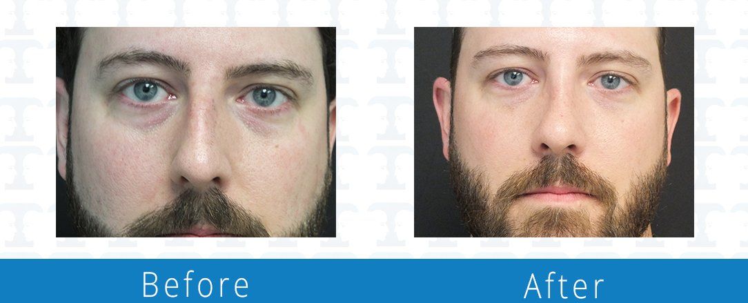 Rhinoplasty before & after from Beaches Facial Plastic & Nasal Surgery Center - the top surgeon for a rhinoplasty or nose job surgery in Jacksonville or Northeast Florida. 