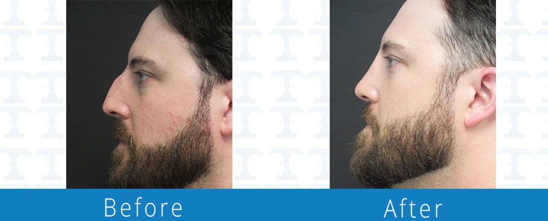 Rhinoplasty before & after from Beaches Facial Plastic & Nasal Surgery Center - the top surgeon for a rhinoplasty or nose job surgery in Jacksonville or Northeast Florida. 