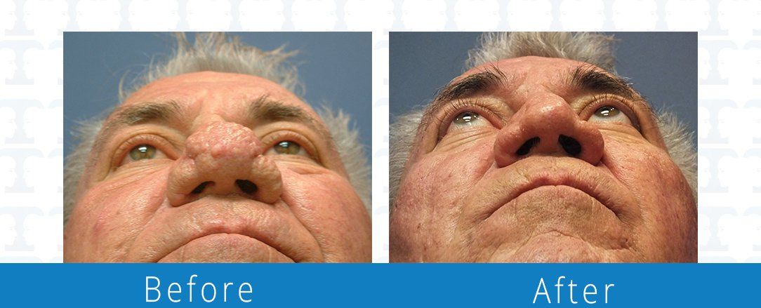 Rhinophyma before & after from Jacksonville plastic surgery and the premiere spot for an rhinophyma surgery in Northeast Florida. 