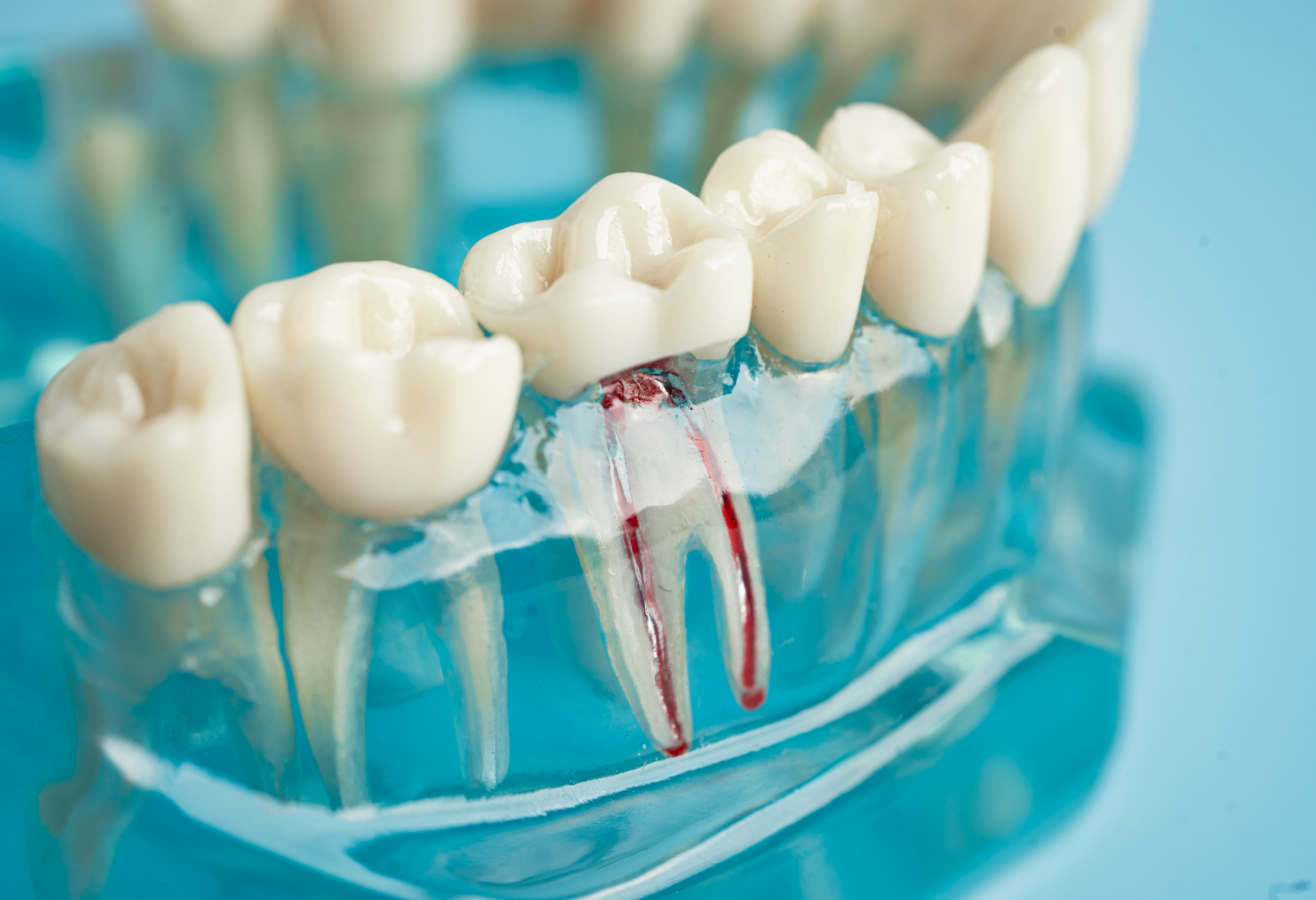 Dental model showing tooth with root canal and exposed pulp.