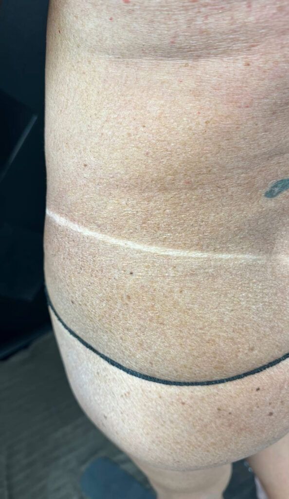 Tan skin with horizontal and curved lines, possibly marking an area for a medical procedure.