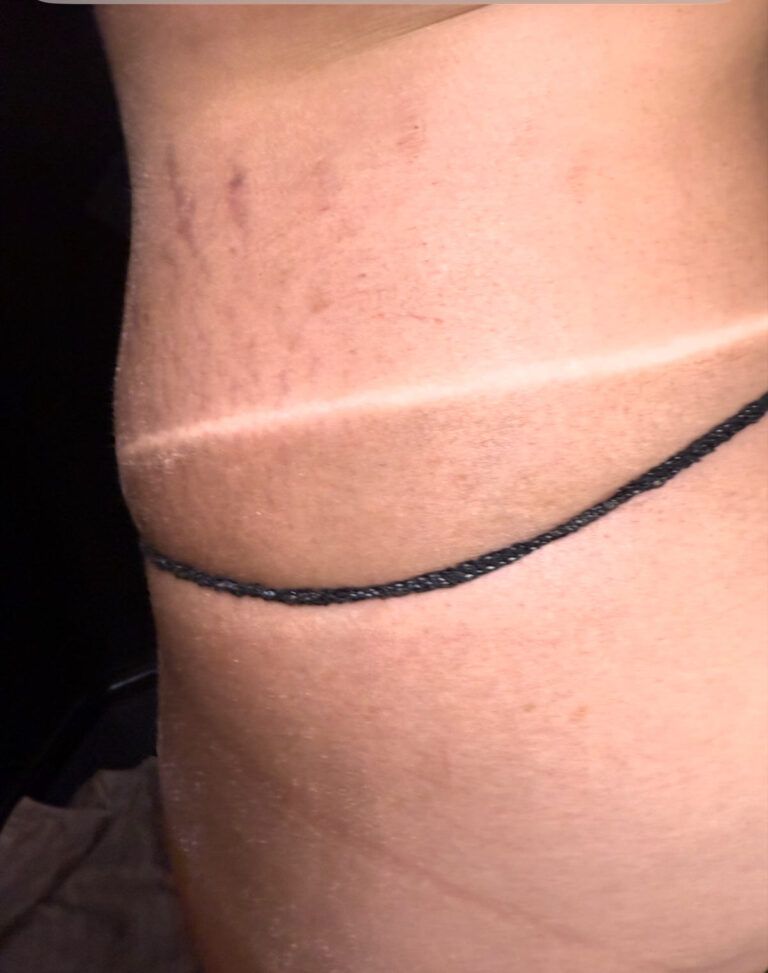 Close-up of a person's side with a tan line and a black line. The skin shows slight discoloration.