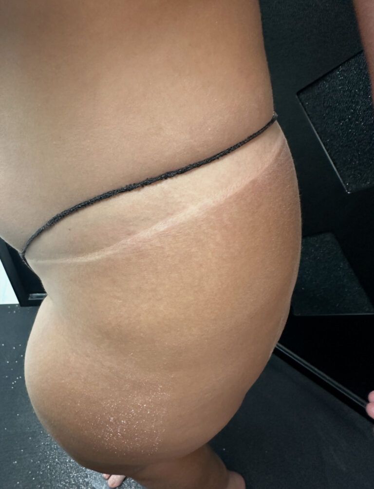 Tan line on hip from a string bikini. Brown skin, dark line of bikini.