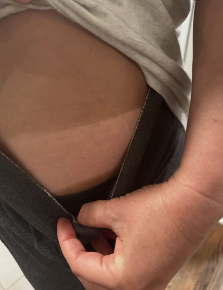 Person’s abdomen showing a distinct tan line from wearing shorts. Hand pulls back clothing.