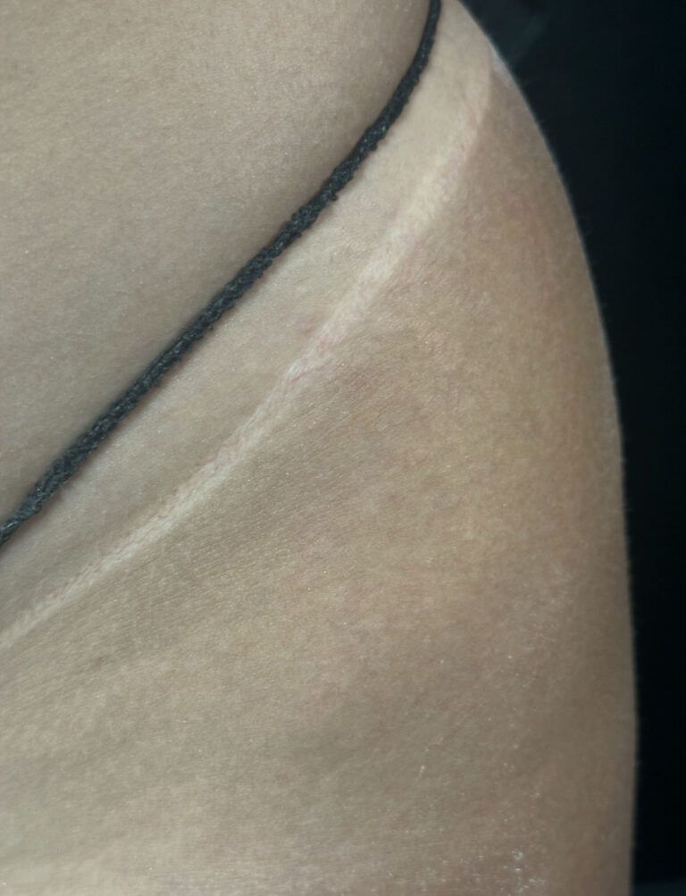 Tan line on a pale thigh, bordered by a dark line.
