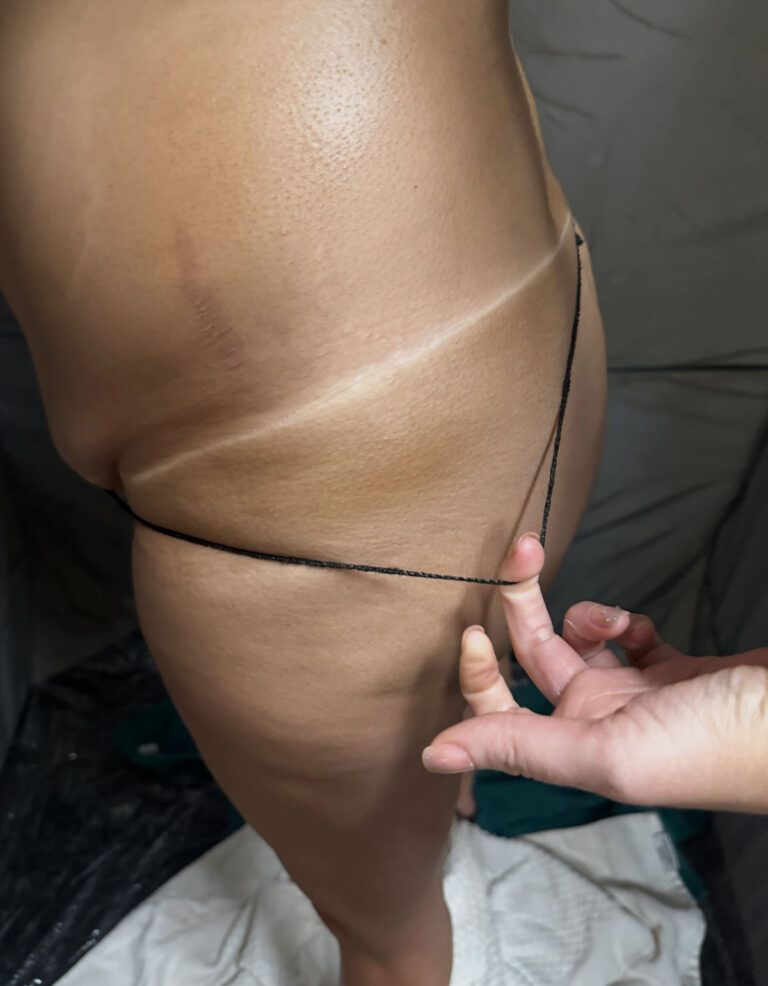 Person's leg and hip with tan lines. A hand holds a black string. Darker areas suggest a bathing suit.