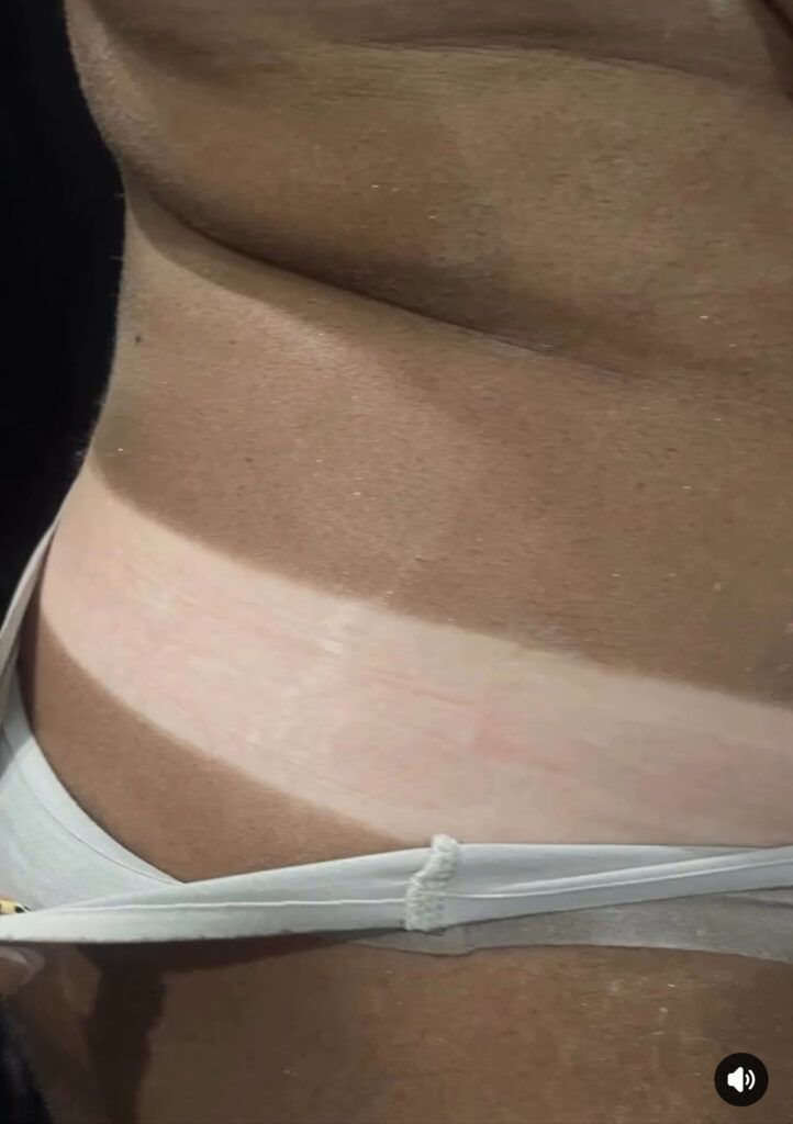 Person's torso with prominent tan lines from clothing. Skin tones vary from pale to deep tan.