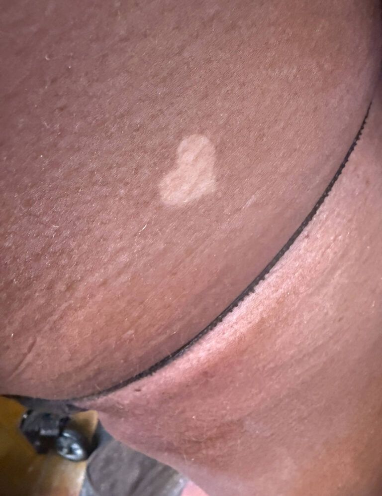 Heart-shaped light skin patch on dark skin, near pantyhose waistband.