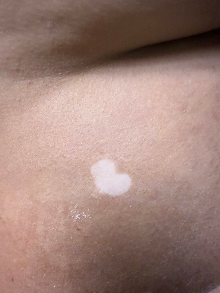Close-up of skin with a heart-shaped white patch, likely vitiligo, surrounded by lighter-toned skin.