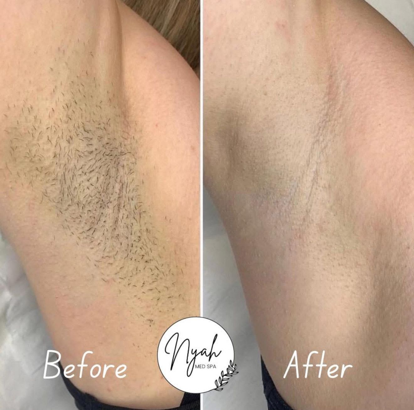 Armpit hair before and after waxing, revealing smooth skin after hair removal.