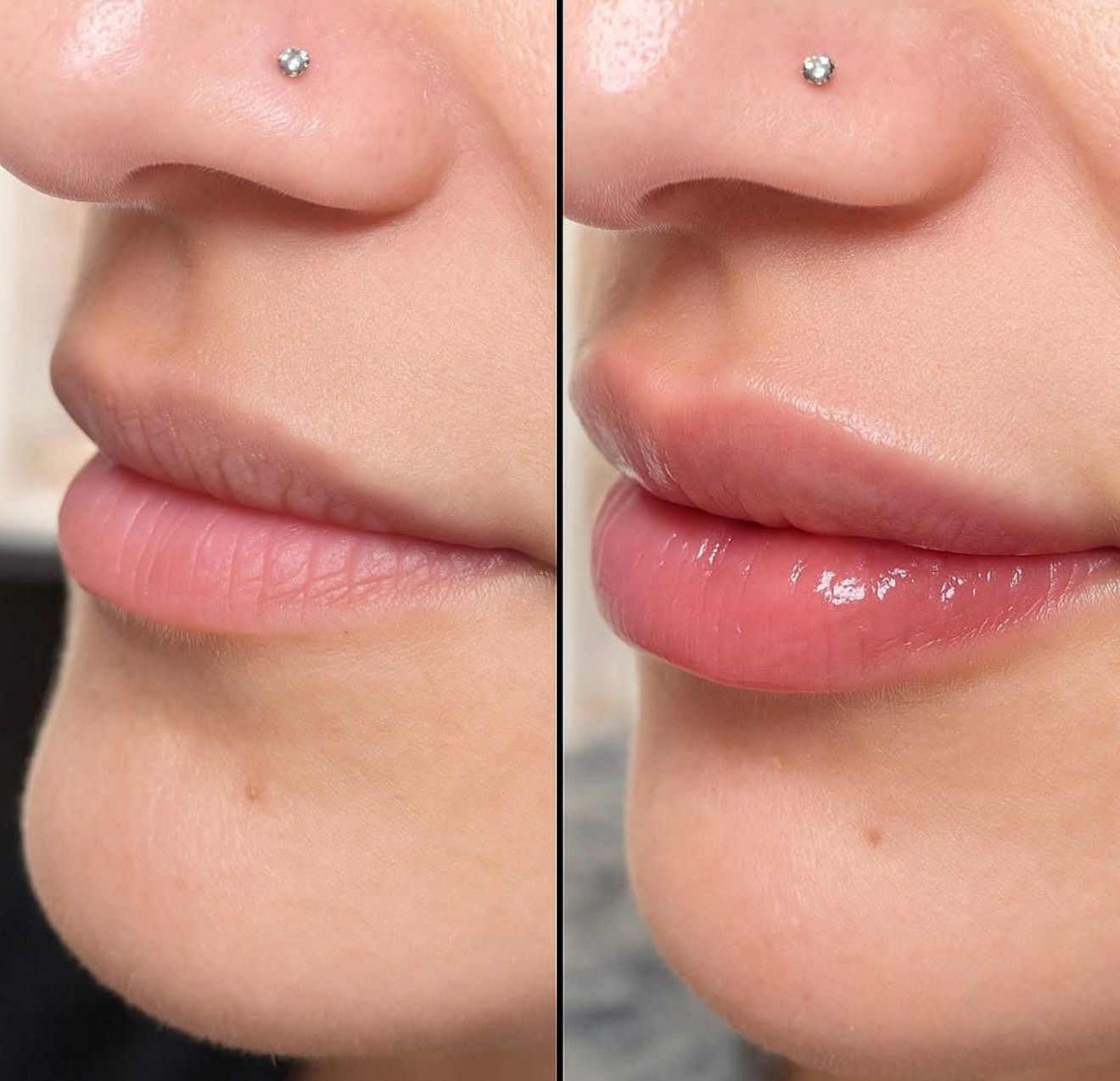 Comparison of lips before and after a lip enhancement.